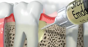 歯ぐき再生治療